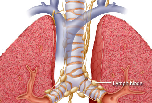 Làm thế nào để phát hiện và điều trị bệnh ung thư phổi?